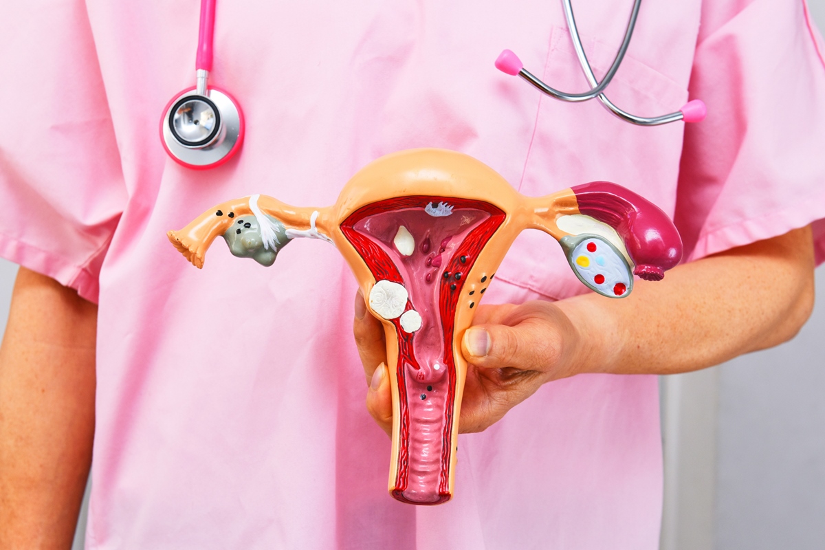 1 de 1 Cirurgião segurando modelo anatômico de patologias comuns. Conceito de câncer ou endome...