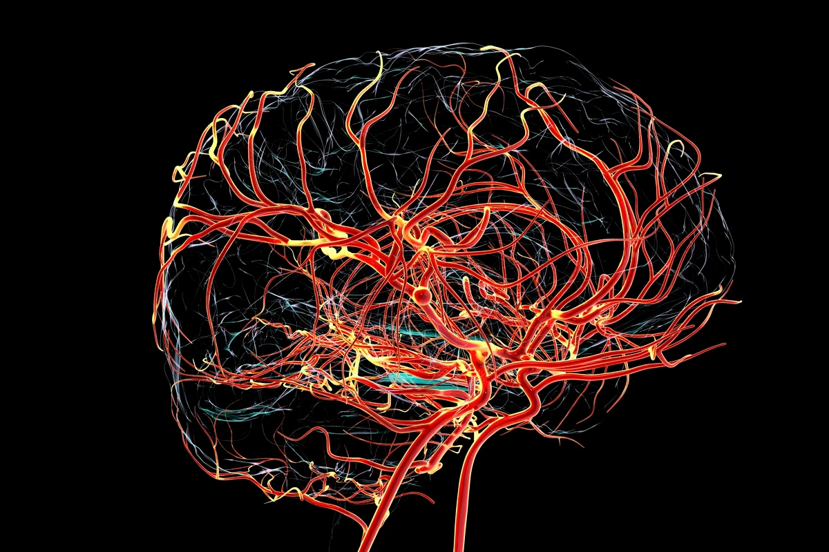 1 de 1 Ilustração de um aneurisma sacular (em forma de baga) na artéria cerebral média, desta...