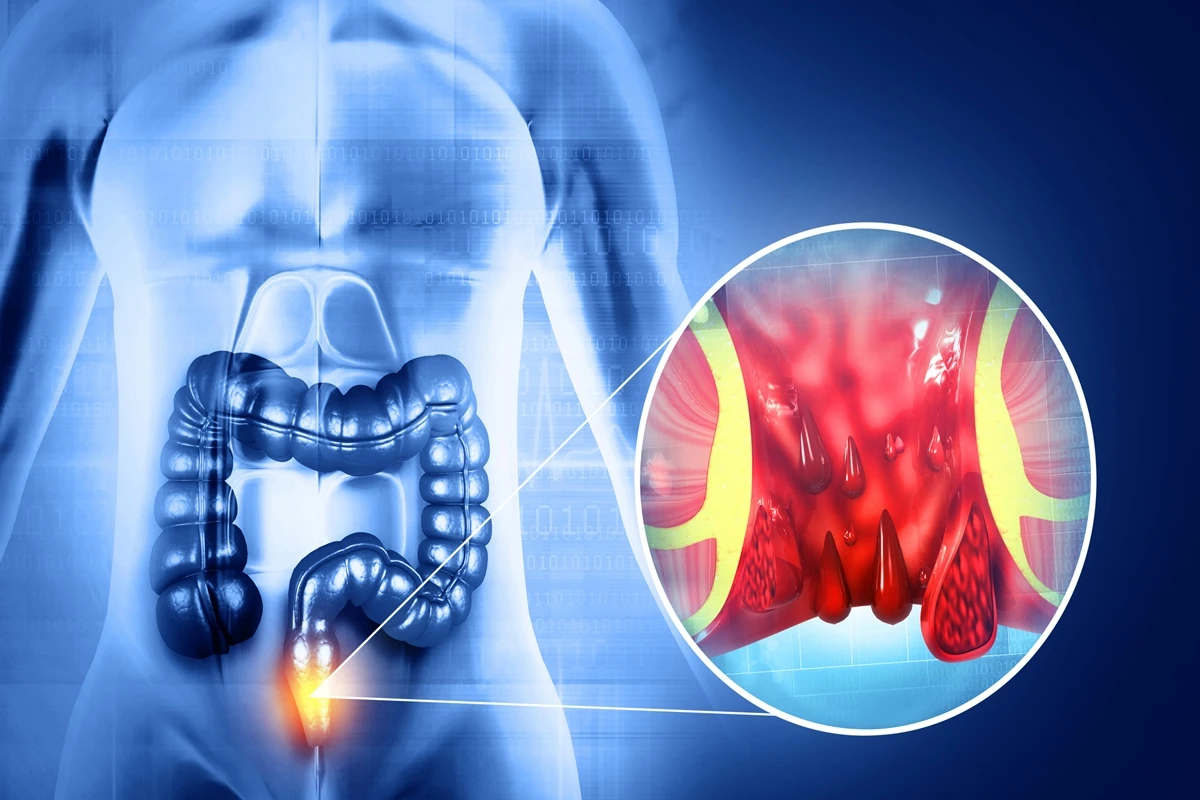1 de 1 Ilustração médicamostra a formação das hemorroidas - Foto: Getty Images