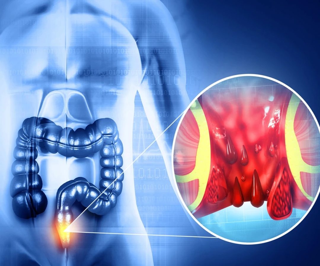 1 de 1 Ilustração médicamostra a formação das hemorroidas - Foto: Getty Images