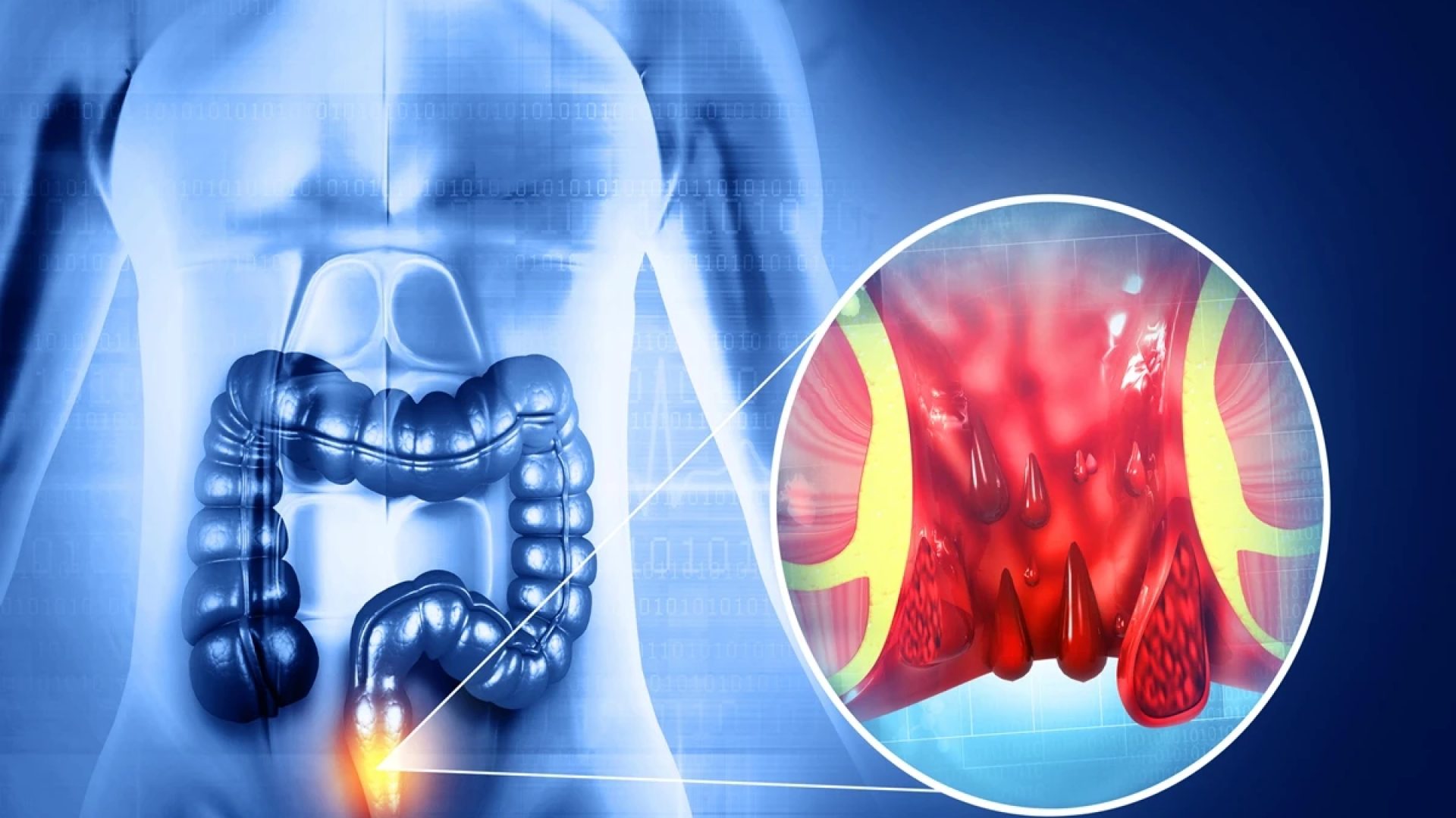 1 de 1 Ilustração médicamostra a formação das hemorroidas - Foto: Getty Images