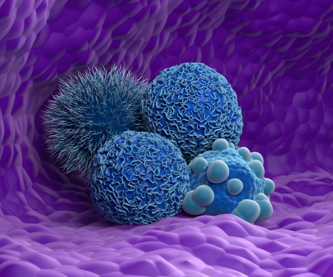 1 de 1 Ilustração mostra células cancerígenas em azul, em um fundo roxo - 6 tipos de câncer ...