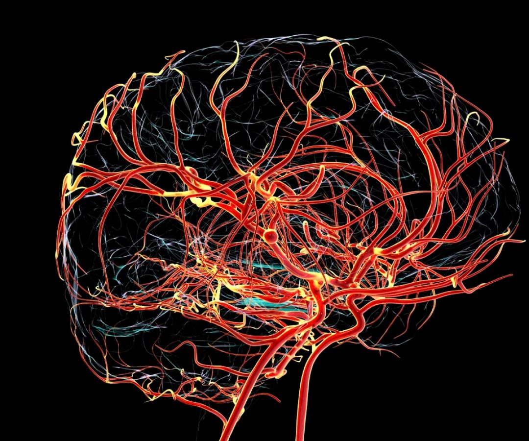1 de 1 Ilustração de um aneurisma sacular (em forma de baga) na artéria cerebral média, desta...