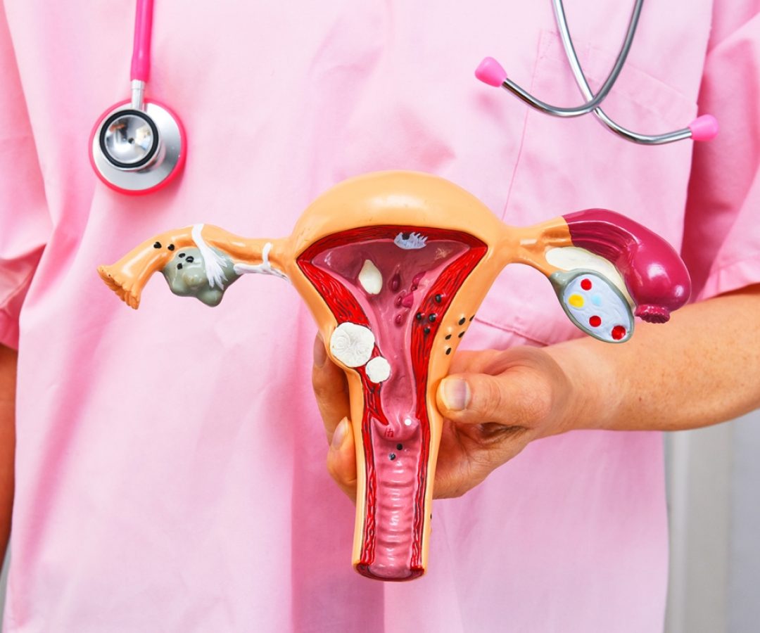 1 de 1 Cirurgião segurando modelo anatômico de patologias comuns. Conceito de câncer ou endome...